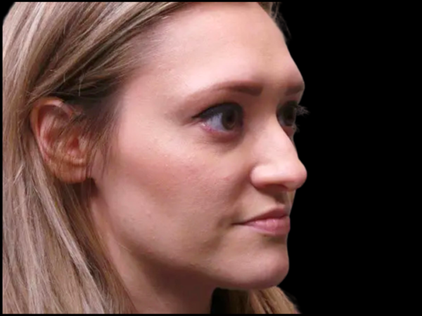 Rhinoplasty Patient 04 Before 2