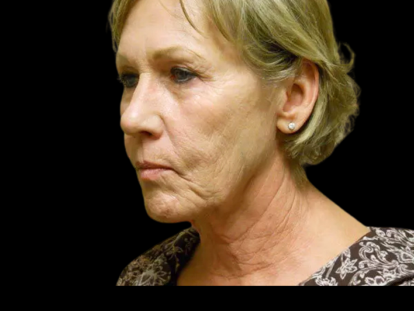 Facelift Patient 12 Before 2