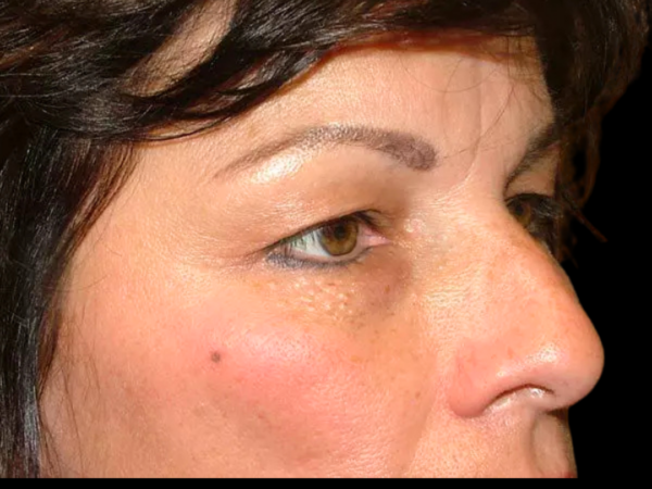 Eyelid Surgery Patient 07 Before 1