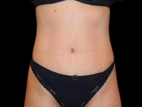 Tummy Tuck Patient 10 After 1