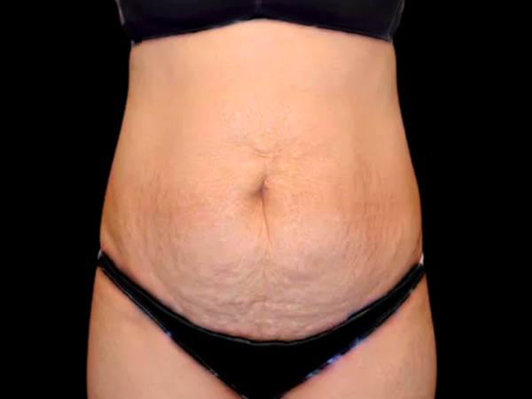 Tummy Tuck Patient 10 Before 1