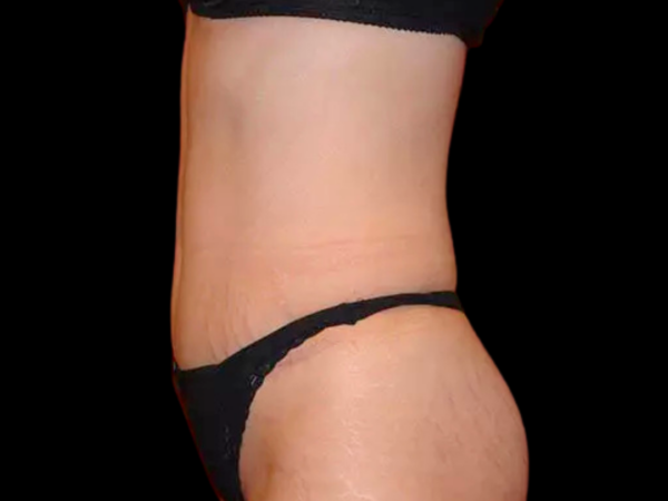 Tummy Tuck Patient 10 After 2