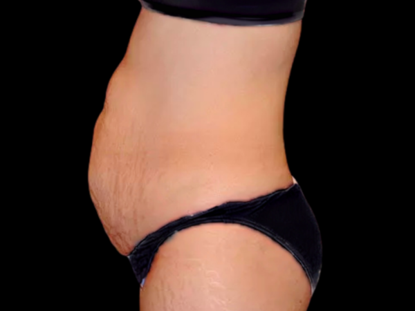 Tummy Tuck Patient 10 Before 2