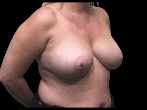 Breast Augmentation with Lift Patient 20 After 2