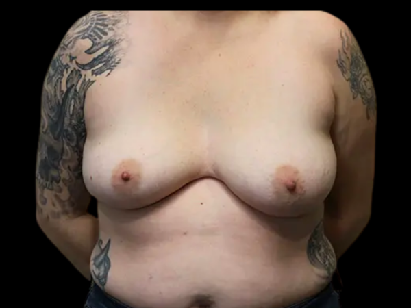 Breast Implant Removal Patient 15 After 1