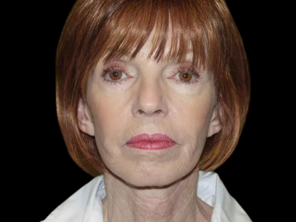 Facelift Patient 11 After 1