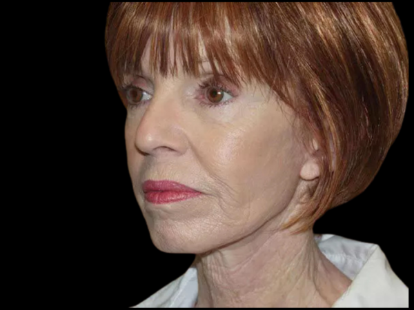 Facelift Patient 11 After 2