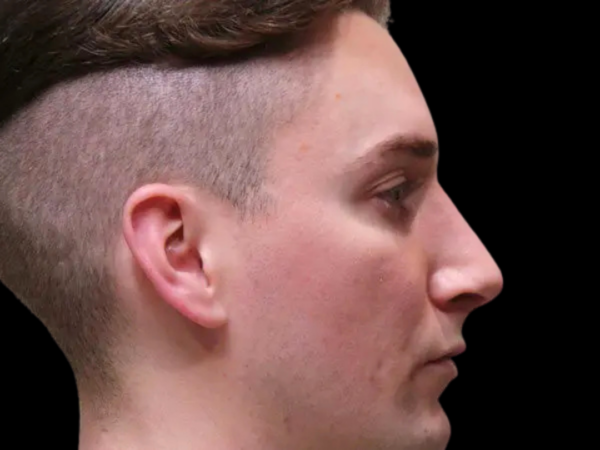 Rhinoplasty Patient 03 After 2