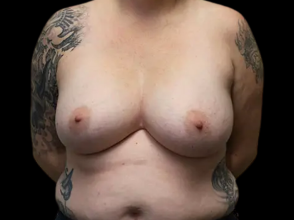 Breast Implant Removal Patient 15 Before 1