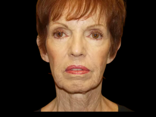 Facelift Patient 11 Before 1