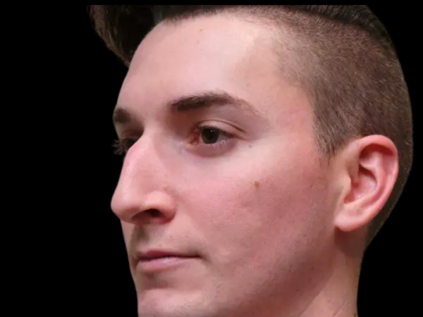 Rhinoplasty Patient 03 Before 1