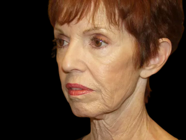 Facelift Patient 11 Before 2