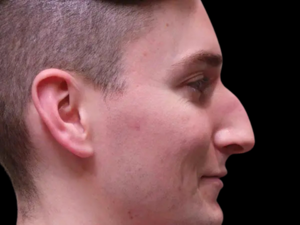 Rhinoplasty Patient 03 Before 2