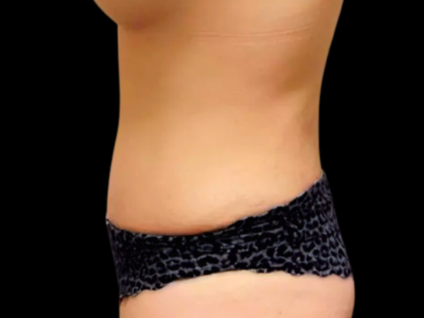 Tummy Tuck Patient 12 After 1