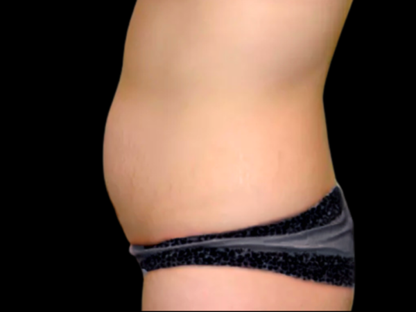 Tummy Tuck Patient 12 Before 1