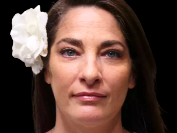 Eyelid Surgery Patient 11 After 1