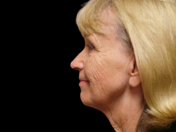 FaceLift Patient 13 Before 1