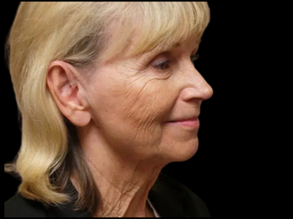 FaceLift Patient 13 Before 2