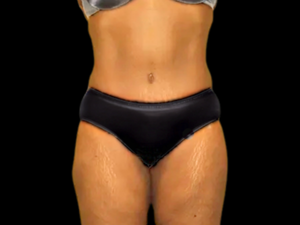 Tummy Tuck Patient 16 After 1