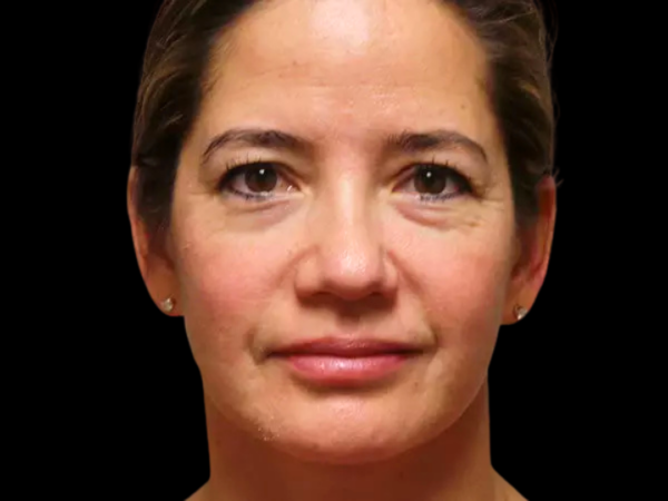 Eyelid Surgery Patient 16 Before 1