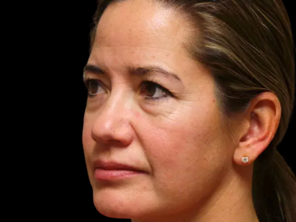 Eyelid Surgery Patient 16 Before 2