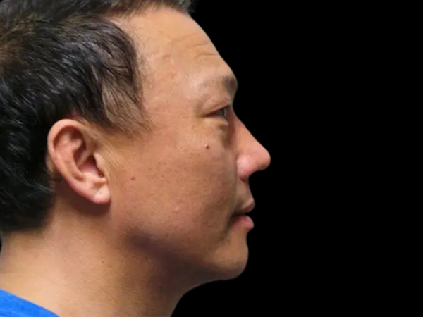 RHINOPLASTY PATIENT 13 After 1