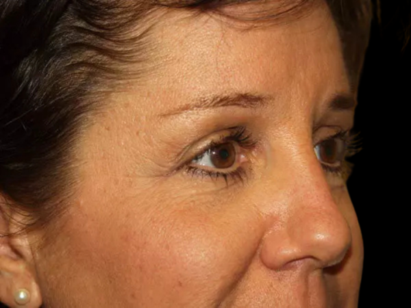 Eyelid Surgery Patient 20 After 2
