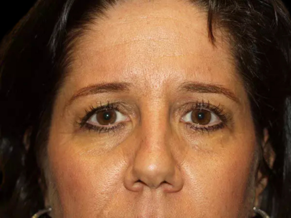 Eyelid Surgery Patient 20 Before 1
