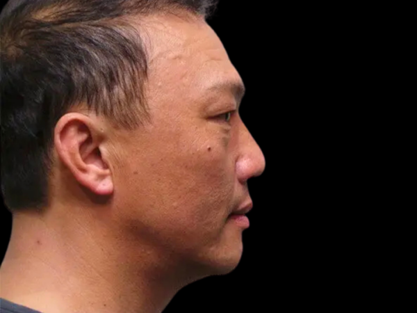 RHINOPLASTY PATIENT 13 Before 1