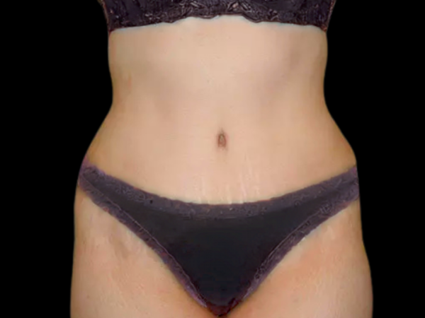 Tummy Tuck Patient 20 After 1