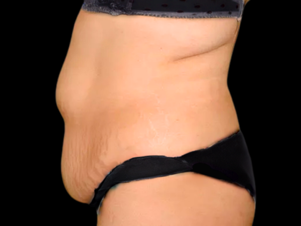 Tummy Tuck Patient 20 Before 2