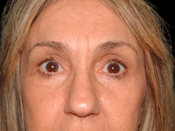 Eyelid Surgery Patient 19 After 1