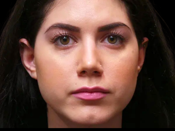 Rhinoplasty Patient 07 After 1