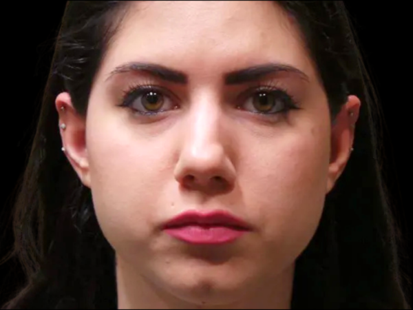 Rhinoplasty Patient 07 Before 1