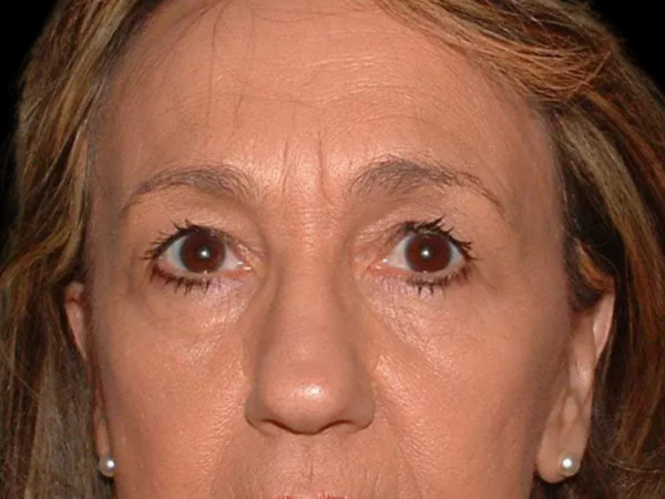 Eyelid Surgery Patient 19 Before 1