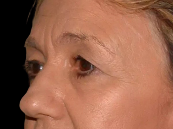 Eyelid Surgery Patient 19 Before 2