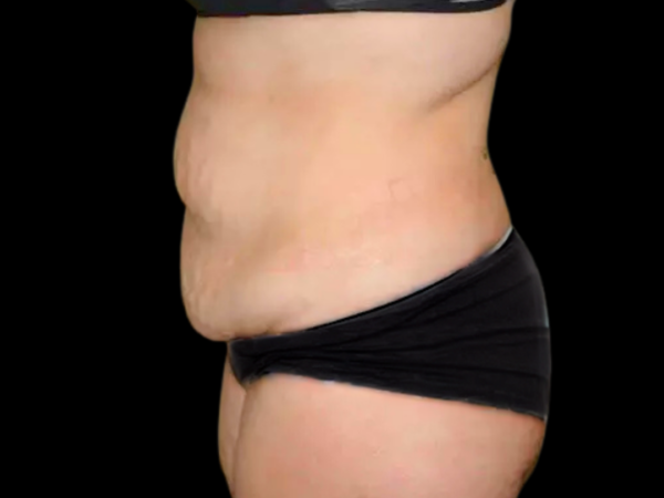 Tummy Tuck Patient 21 Before 1