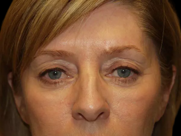 Eyelid Surgery Patient 21 Before 1
