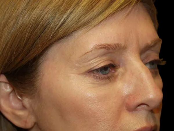 Eyelid Surgery Patient 21 Before 2