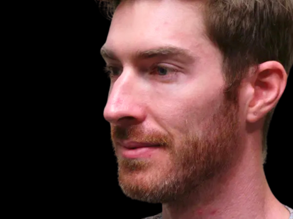 Rhinoplasty Patient 09 Before 2