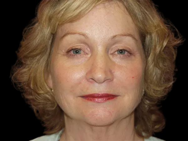 Eyelid Surgery Patient 21 After 1