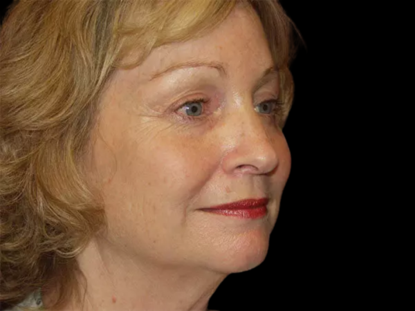 Eyelid Surgery Patient 21 After 2