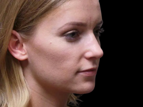 Rhinoplasty #1494 After 2