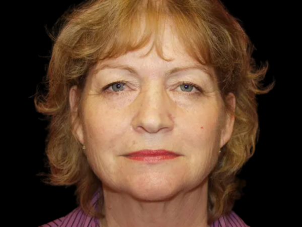 Eyelid Surgery Patient 21 Before 1