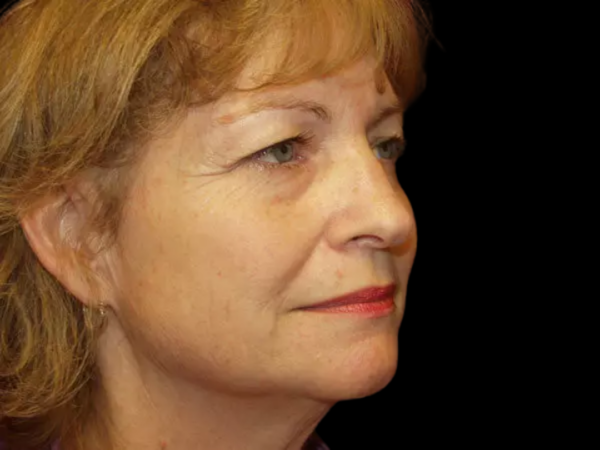 Eyelid Surgery Patient 21 Before 2