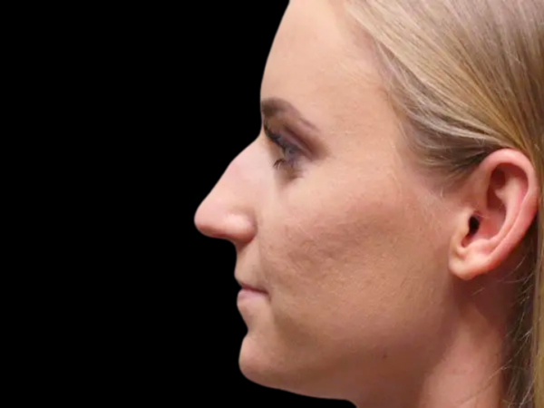 Rhinoplasty #1494 Before 1