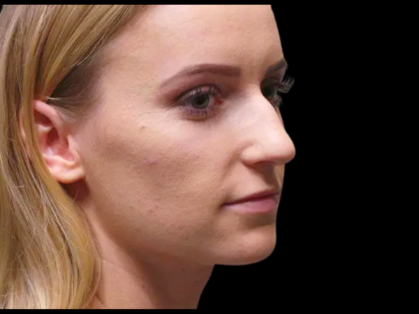 Rhinoplasty #1494 Before 2