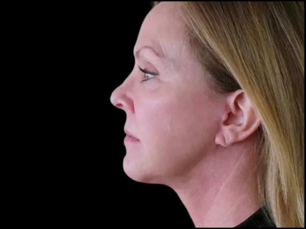 FaceLift Patient 01 After 2