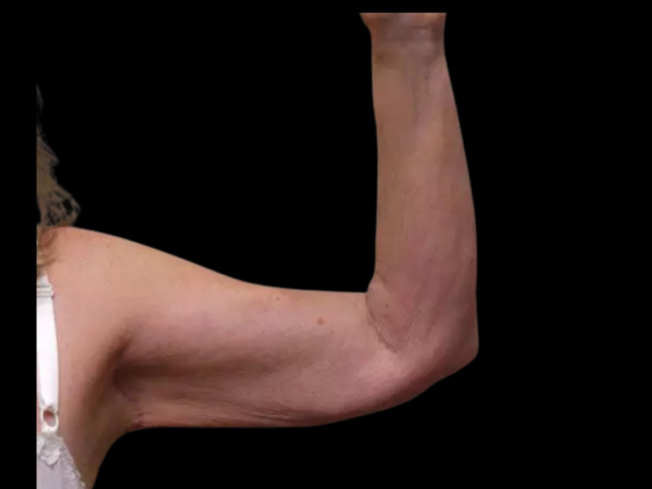 Arm Lift Patient 01 After 1