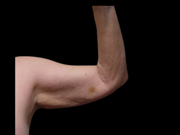 Arm Lift Patient 01 Before 1